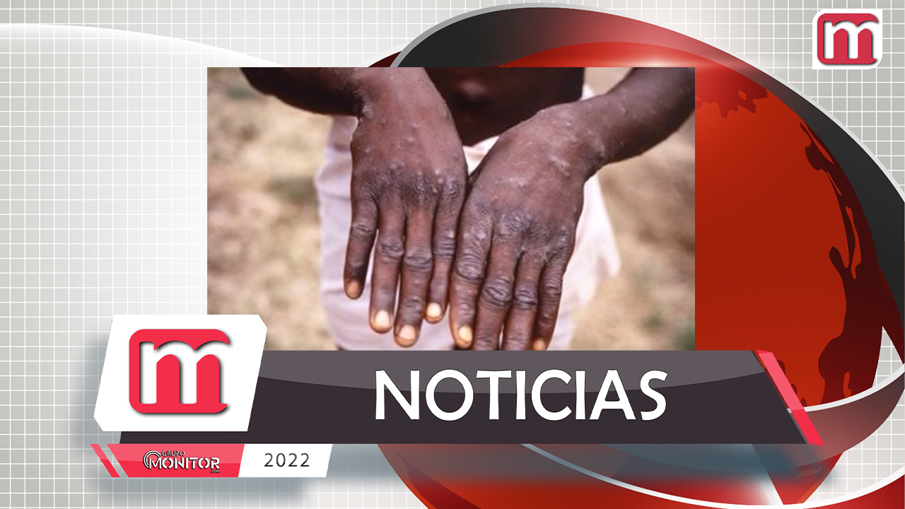 Confirma México primer caso importado de viruela símica